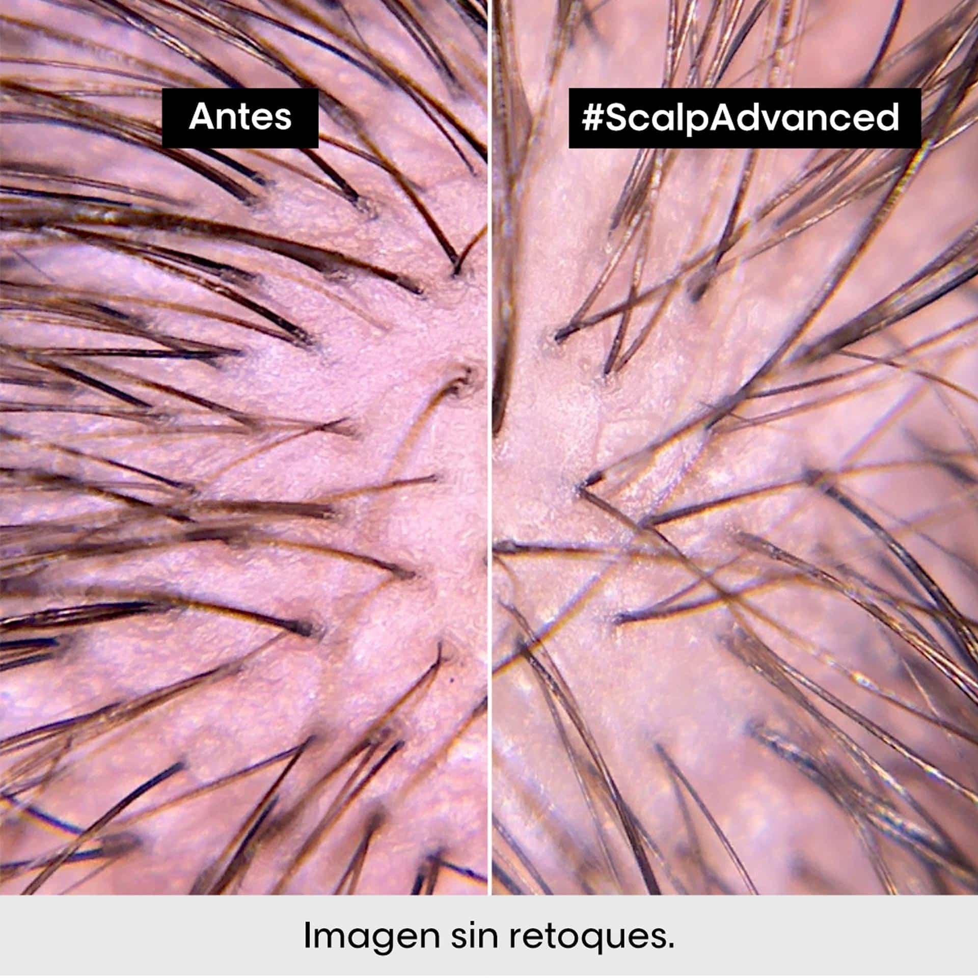 L'Oréal Professionnel Scalp Advanced Anti-Discomfort – Tratamiento Calmante Intensivo para Cuero Cabelludo Sensible