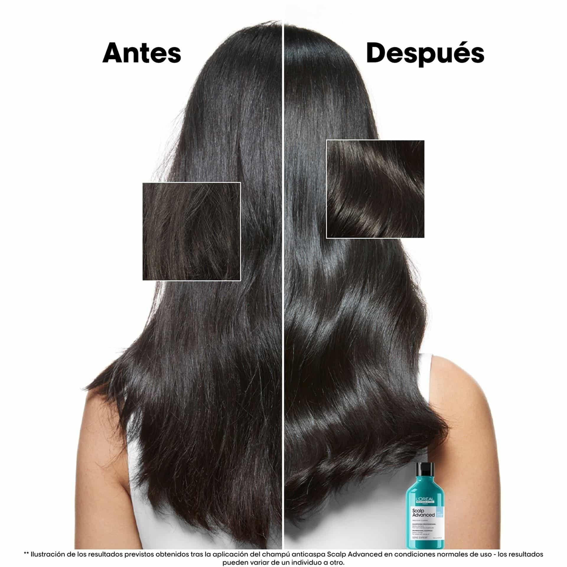 L'Oréal Professionnel Scalp Advanced Anti-Dandruff – Champú Anticaspa para Cuero Cabelludo con Caspa